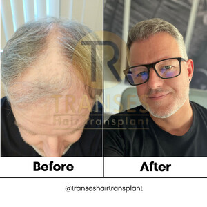 Image of Transes Hair Transplant Gallery 6