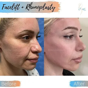 Image of Facelift and Rhinoplasty