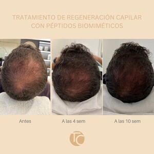 Image of Hair loss treatment in Barcelona