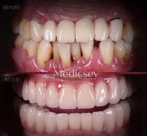 Image of Dental implants