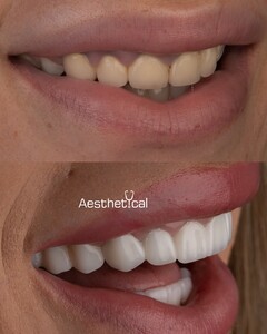 Image of Teeth Whitening - Aesthetical Clinic