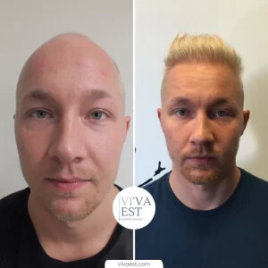 Image of Hair transplant before and after