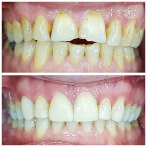 Image of Veneers