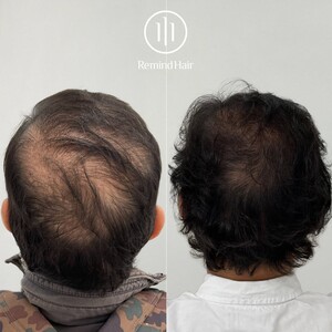 Image of Hair transplant