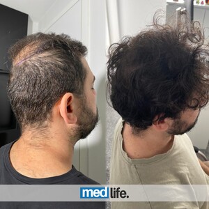 Image of Medlife Group - Hair Transplant Gallery 2