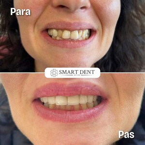 Image of Smile makeover before and after