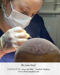 Image of CC Hair Transplant Gallery 0