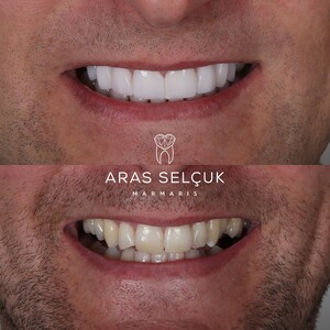 Image of Porcelain veneers - Dentist Aras Selçuk 