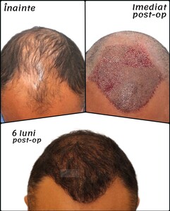 Image of Dr Felix Hair Implant Gallery 2