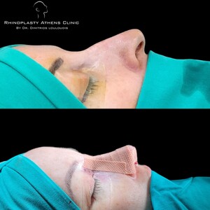 Image of Rhinoplasty Athens Clinic by Dimitris Louloudis Gallery 0