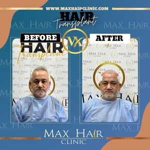 Image of FUE Hair transplant