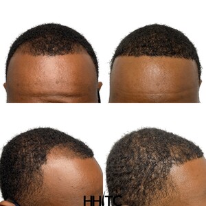 Image of Houston Hair Transplant Center - Dr. Goran Jezic Gallery 0