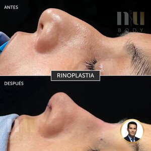 Image of Rhinoplasty