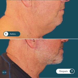 Image of Chin liposuction