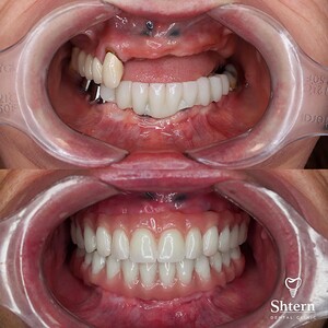 Image of Dental implants