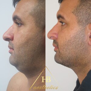 Image of HB Aesthetics - Dr. Hakan BULAM Gallery 0