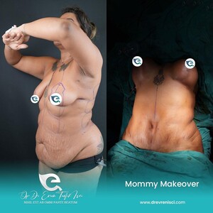 Image of Mommy makeover