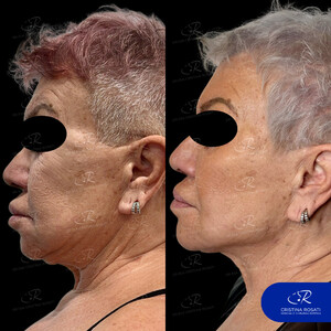 Image of Facial plastic surgery before and after