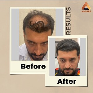 Image of Hair Transplantation Before and After