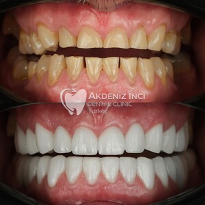 Image of Zirconium Crowns - Akdeniz Inci Dental Clinic