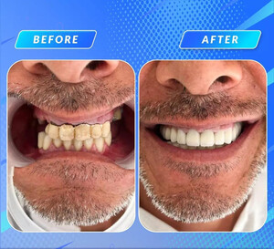 Image of Smile Makeover - Göcek Dent