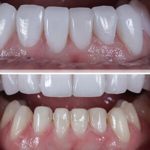 Image of Porcelain veneers