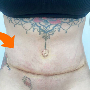 Image of Tummy tuck