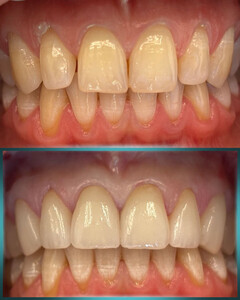 Image of Teeth Cleaning - Dr Popovic