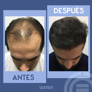 Image of Before and after hair transplant