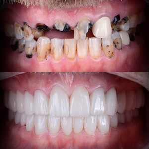 Image of Dental crowns