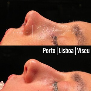 Image of Rhinoplasty surgery - Porto Nose Clinic