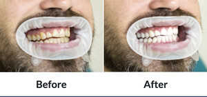 Image of Teeth whitening