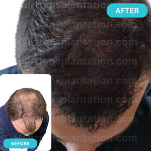 Image of Hairtransplantation.com Gallery 2