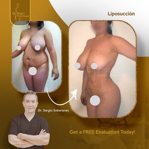 Image of Before and after liposuction