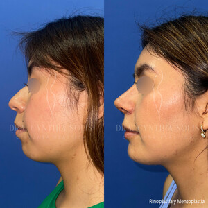 Image of Rhinoplasty, mentoplasty