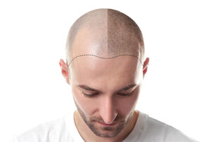 Image of Genesis Hair Transplant Gallery 0