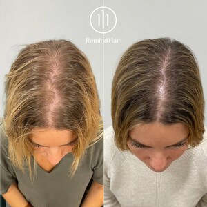 Image of Hair transplant for women