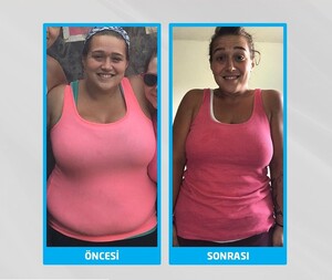 Image of Weight loss surgery before and after