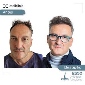 Image of Before and after hair transplant