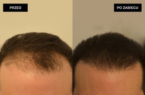 Image of Dr. Pyziak Hair Transplant Center Gallery 3