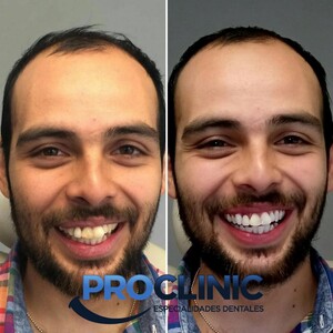 Image of Teeth whitening before and after