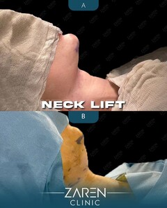 Image of Neck Lift