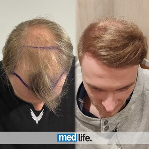 Image of Medlife Group - Hair Transplant Gallery 0