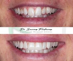 Image of Veneers - Farfaras Dental Clinic