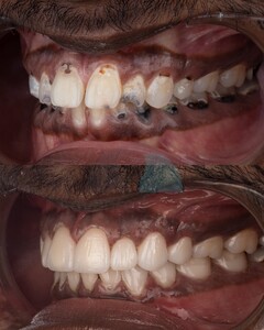 Image of Hollywood smile