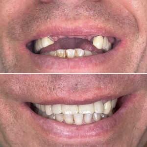 Image of Dental implants - Dr. Teodora Dumitriu