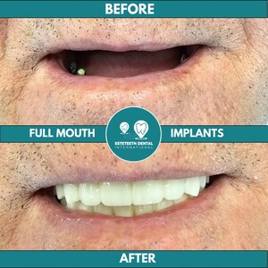 Image of Full Mouth Implants - Esteteeth Dental