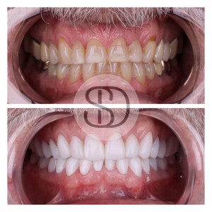 Image of Full Mouth Restoration with zirconia crowns