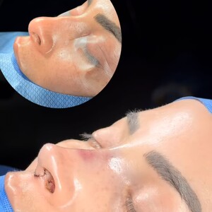 Image of Rhinoplasty