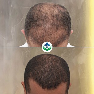 Image of Colombia Care Hair Transplant Gallery 1